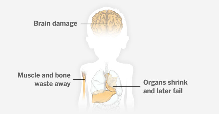 Acute Malnutrition in Gaza’s Children: Potential Long-term Health Implications