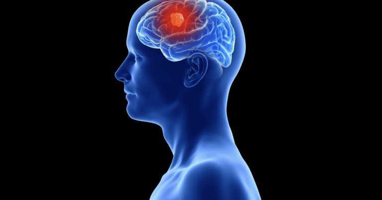 Scientists reveal the impact of glioblastoma on the skull